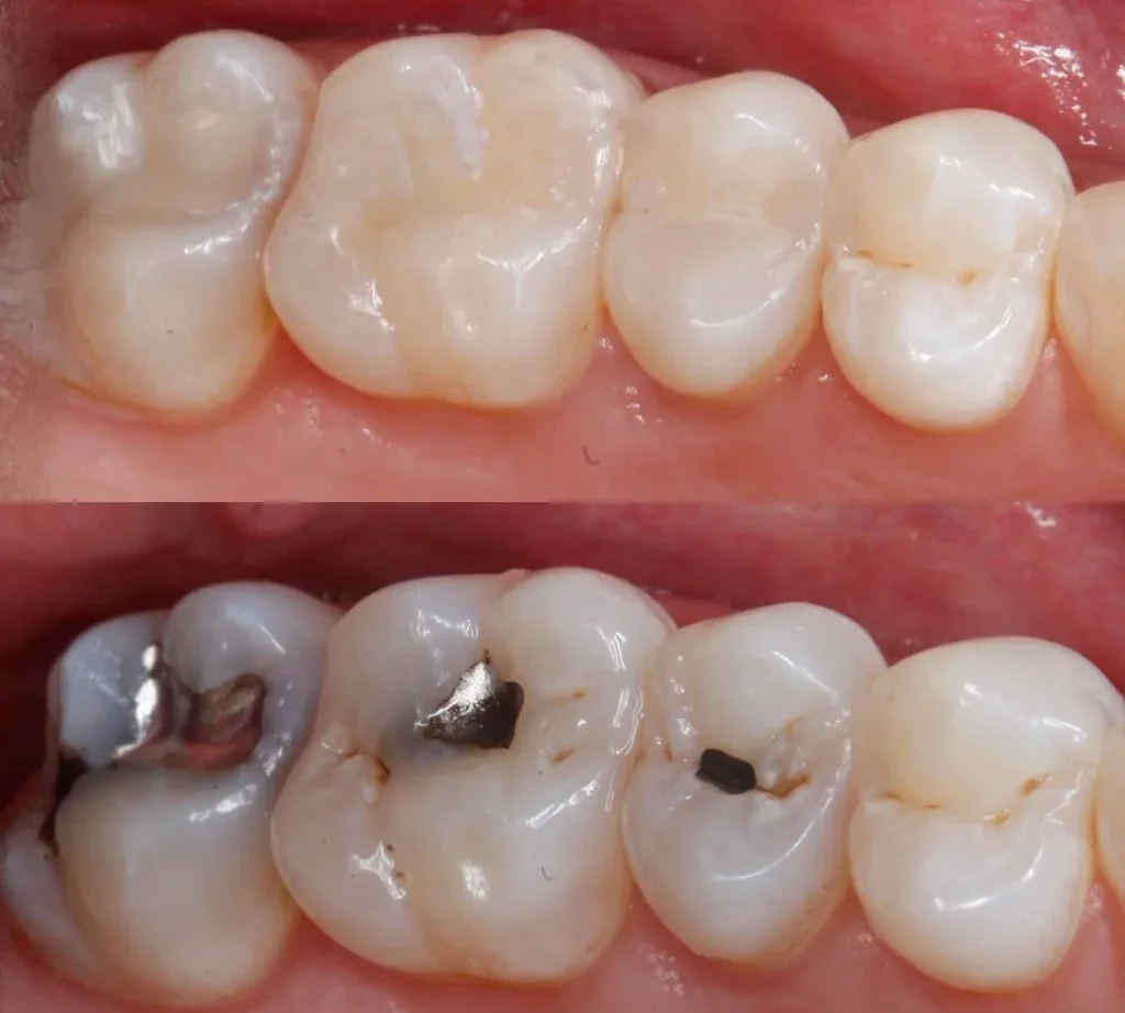 posterior resin fillings before and after photo of teeth with amalgam fillings on the bottom and teeth with resin tooth colored fillings on the top